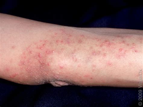 Celiac Disease Rash: Overview, Symptoms and Treatment - HealthPulls