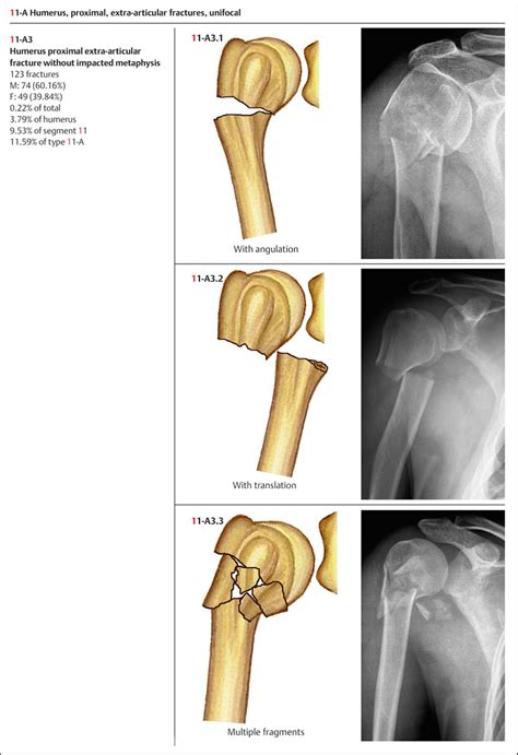 Mechanisms Of Humeral Head Fracture