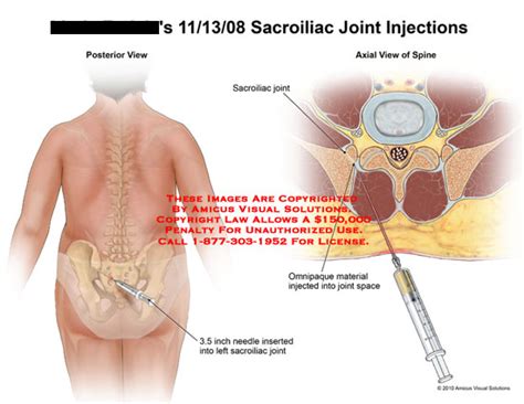 Sacroiliac Joint Injections