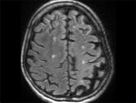 giungla Dispendiosamente comuni lewy body dementia mri adatto ...