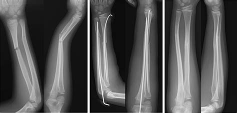 Case presentation of a case treated with intramedullary nailing. (Left:... | Download Scientific ...