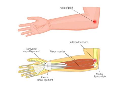 Medial Epicondylitis| Golfer’s Elbow| Flexor Mass Tendon Tear |Orthopedic Elbow Specialist ...