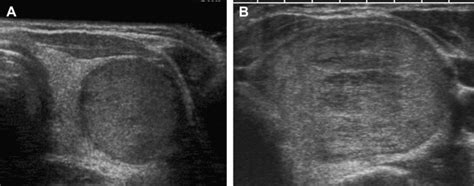 Colloid Nodule Thyroid Ultrasound