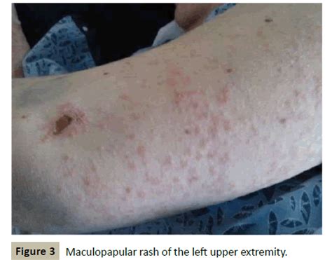 A Fatal Case of Levamisole-Induced Vasculitis | Insight Medical Publishing