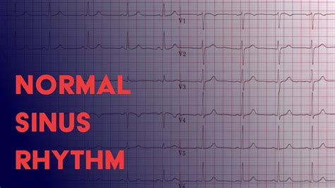 Normal Sinus Rhythm - EKG (ECG) Interpretation - YouTube