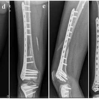 A 48-year-old man with a distal femoral fracture underwent surgery with... | Download Scientific ...