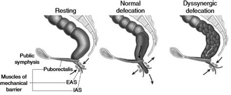 pelvic floor dyssynergia symptoms - Beula Cardwell