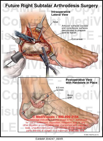 Medivisuals Future Right Subtalar Arthrodesis Surgery Medical Illustration