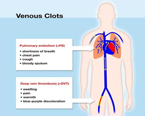 What is a blood clot? | UNC Hemophilia and Thrombosis Center