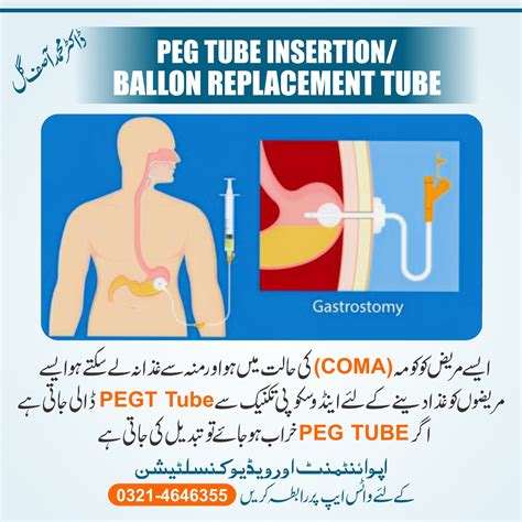 PEG Tube Insertion | drmasifgul