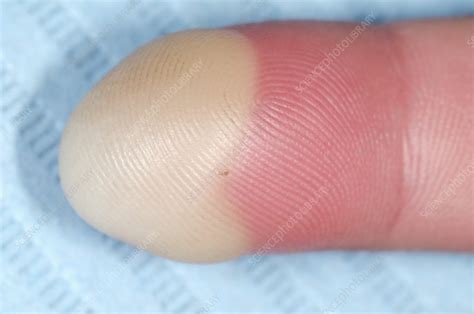 Paronychia infection of the finger - Stock Image - C016/8167 - Science ...