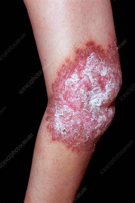 Cutaneous tuberculosis - Stock Image - C034/8797 - Science Photo Library