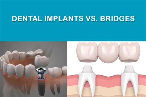 Dental Implants vs. Bridges: Which Is Best for You? | Phillips Ranch