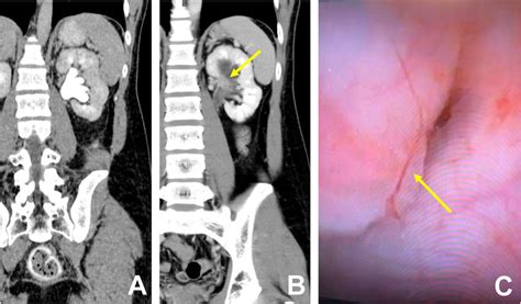 Initial CT scan; the delayed phase revealed left moderate... | Download ...