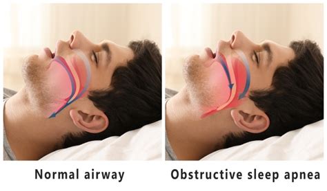 normal-airway-vs-obstructive-sleep-apnea - Texan ENT Specialists