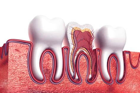 What Causes Exposed Tooth Roots?