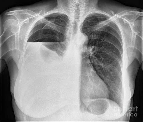 Hydropneumothorax, X-ray Photograph by Science Photo Library - Fine Art America