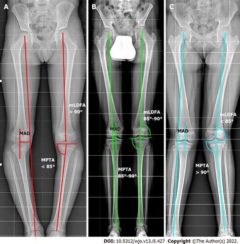 Coronal plane deformity around the knee in the skeletally immature ...