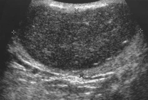 Subcutaneous Dermoid Cyst Ultrasound