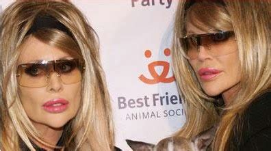 Barbi Twins Plastic Surgery Gone Wrong Before and After Nose Job ...