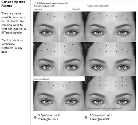 Forehead Botox injection pattern | Botox injection sites, Botox face, Botox injections