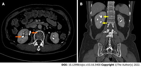 Renal Papillary Necrosis Usmle