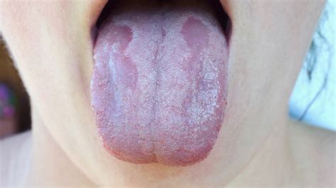 White Patches On Lips And Tongue | Lipstutorial.org