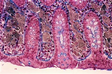 Melanosis Coli Photograph by Cnri