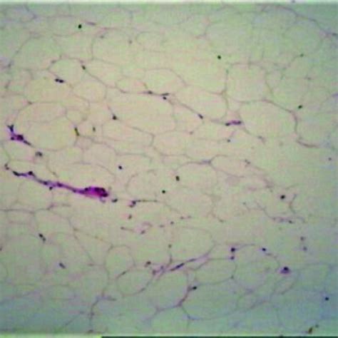 Histological appearances of the lipoma, showing the typical appearance... | Download Scientific ...