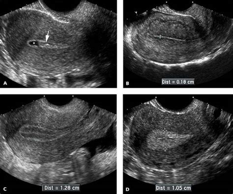 Uterus | Radiology Key