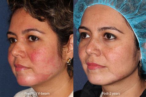 Rosacea Facial Redness Treatment by San Diego Specialists