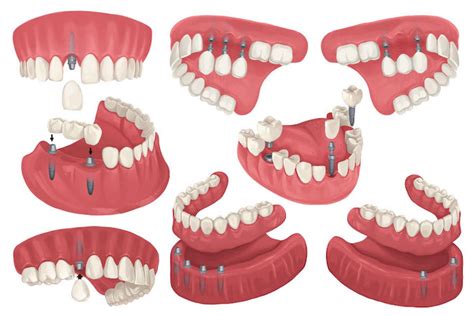 Dental Implants Restoration & its Types - New Columbia Dentistry