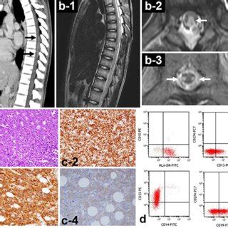 Figure1.a: Contrast-enhanced computed tomography at admission. The... | Download Scientific Diagram