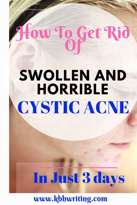 Cystic Acne Remedies