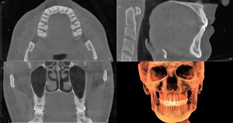 CBCT: What is it and how does it work? - Radiodontics