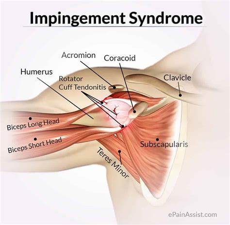 Shoulder Impingement - Mississauga and Oakville Chiropractor and Physiotherapy Clinic - FREE ...