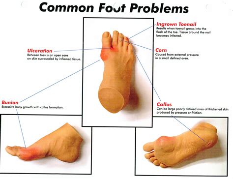 Common Foot Problems #MedicalFootCareCenter #211RedmondRoadRomeGA #DrBrianMiddleton #FootDoctor ...