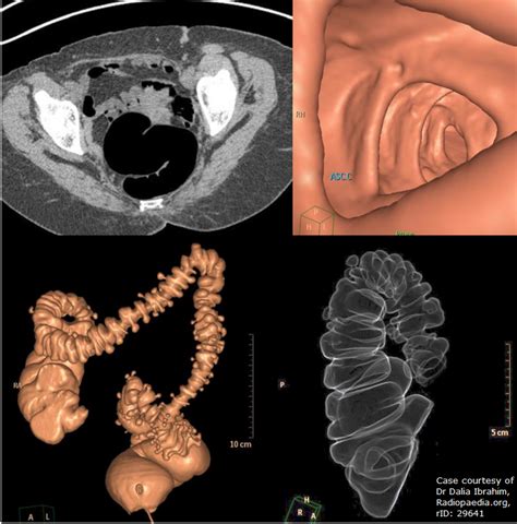 CT Colonography