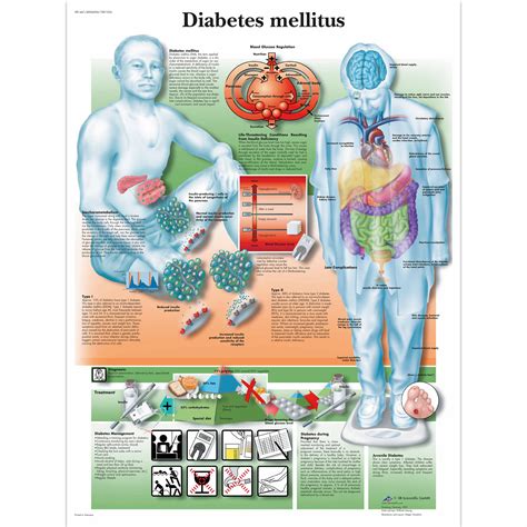 Diabetes Chart - Diabetes Poster - Anatomical Charts - Anatomy Posters - Health Education Charts ...