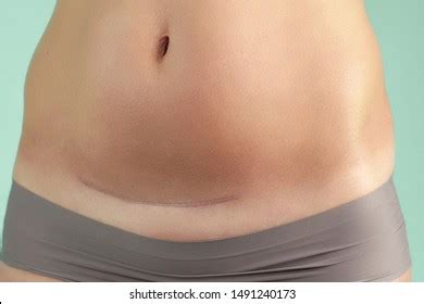 Hysterectomy Images, Stock Photos & Vectors | Shutterstock