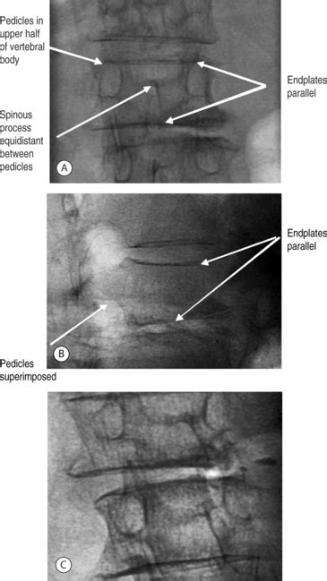 Kyphoplasty Technique | Clinical Gate