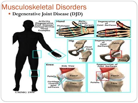 PPT - Musculoskeletal Disorders Part II PowerPoint Presentation, free ...