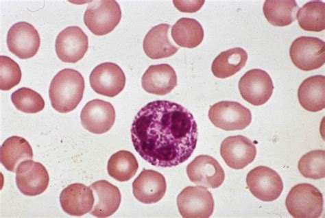 toxic granulation | Pathology Student