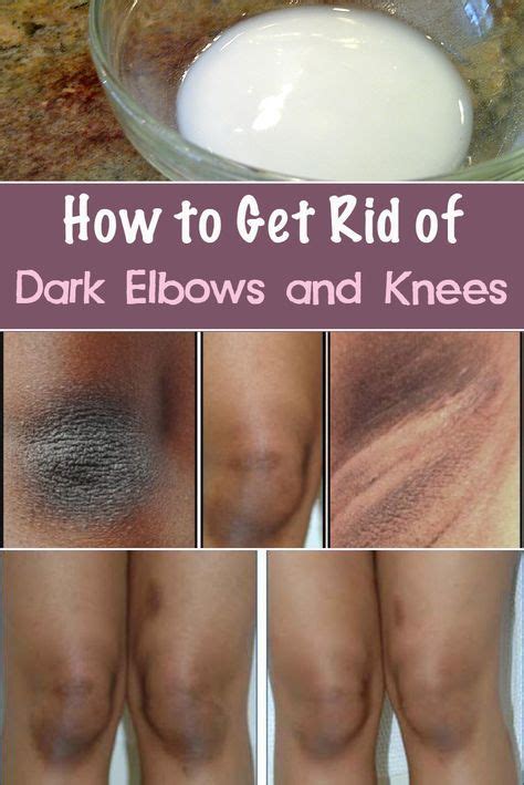 How to Get Rid of Dark Elbows and Knees | Dark elbows, Black skin care, Skin remedies