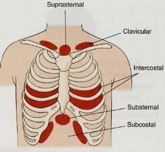 Retractions | Pediatric nursing, Nursing study, Medical knowledge