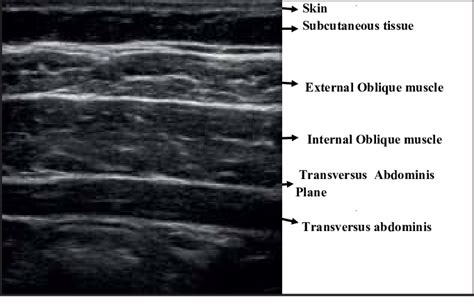 Sonological anatomy of TAP block | Download Scientific Diagram