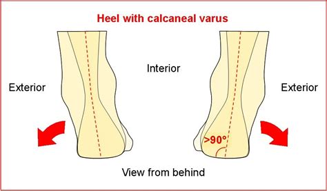 Pathologies > Calcaneal Varus