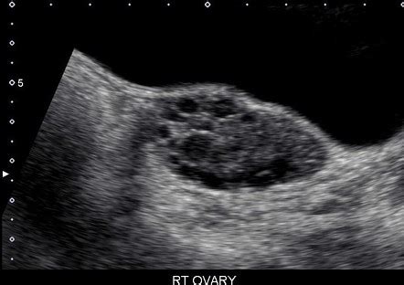 Normal Vs Polycystic Ovaries Ultrasound