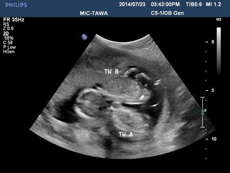 twins ultrasound 15 wks | BabyCenter