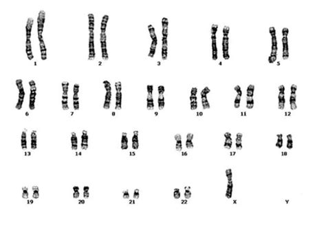 A karyotype of Turner Syndrome- Explained – KaryotypingHub